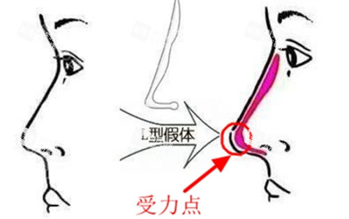 L形隆鼻假体对比.jpg