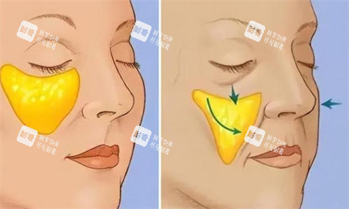 面部苹果肌提升前后对比.jpg 面部苹果肌提升前后对比.jpg