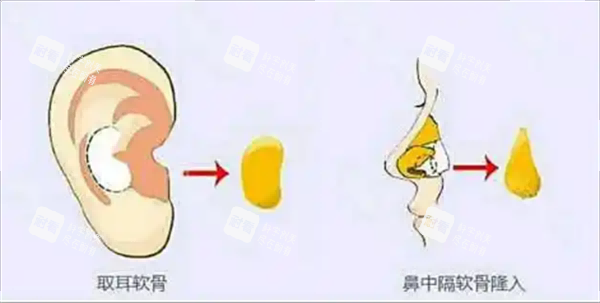 耳软骨隆鼻.png 耳软骨隆鼻.png