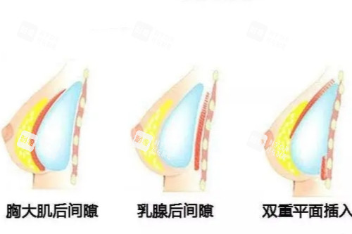 假体隆胸植入位置示意图.jpg 假体隆胸植入位置示意图.jpg
