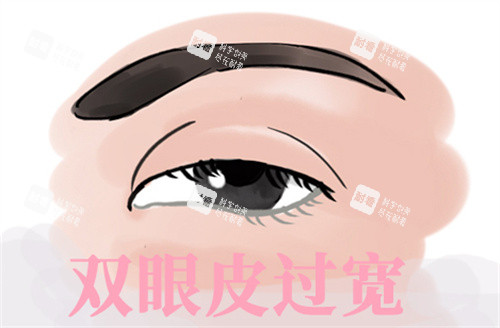 双眼皮过宽修复.jpg 双眼皮过宽修复.jpg