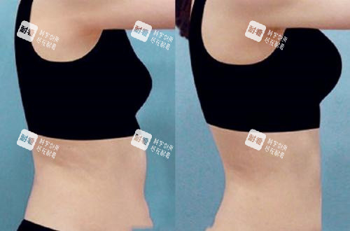 腰腹部吸脂手术前后对比图.jpg 腰腹部吸脂手术前后对比图.jpg