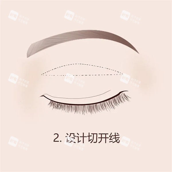 双眼皮手术.jpg
