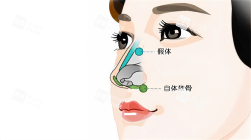 隆鼻卡通示图.jpg