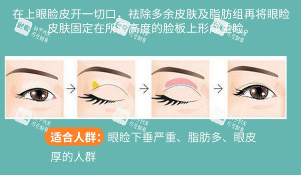 全切双眼皮解析.jpg