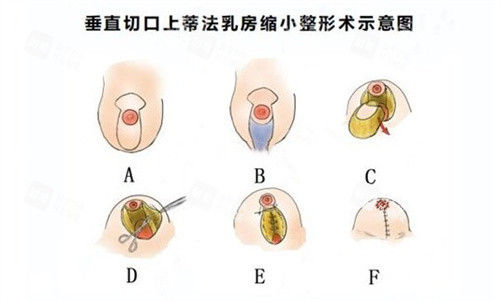 缩胸手术.jpg