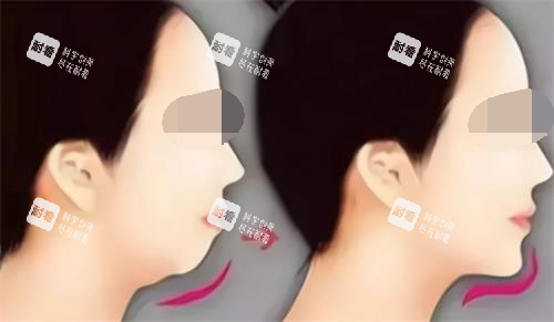玻尿酸丰下巴后的成效.png 玻尿酸丰下巴后的成效.png