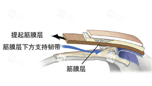 SMAS筋膜层图片展示.jpg