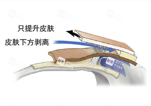 SMAS筋膜层图片.jpg