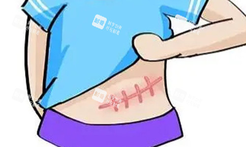 腹部疤痕增生的动画图.jpg 腹部疤痕增生的动画图.jpg