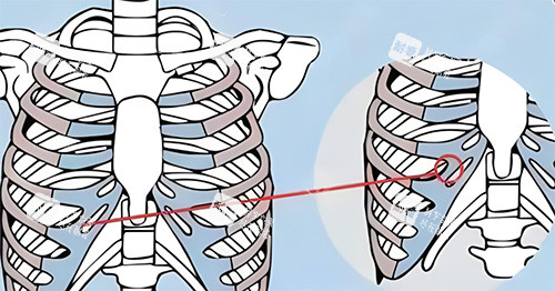 隆鼻肋骨鼻所用肋骨图.jpg