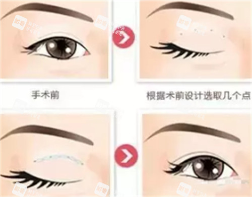 贝塞尔双眼皮手术过程图解.jpg