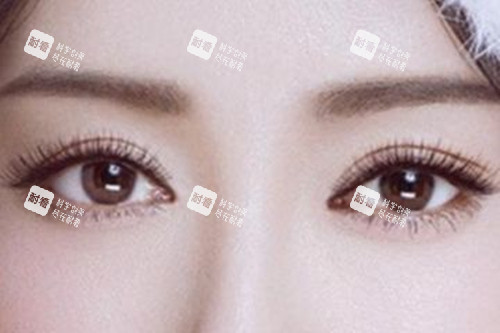 割双眼皮.jpg