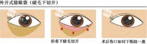 外切法祛眼袋手术步骤.jpg