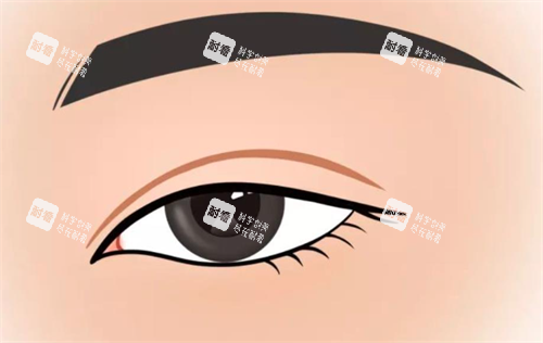 双眼皮手术.png