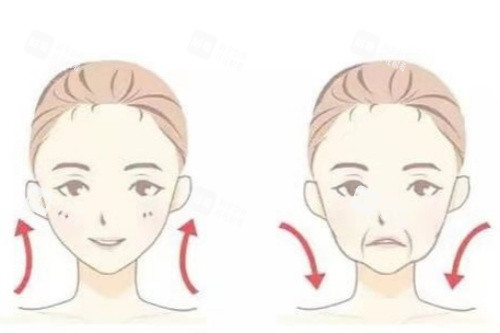 面部脂肪填充卡通对比图.jpg 面部脂肪填充卡通对比图.jpg