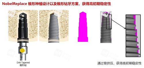 诺贝尔种植牙 (2).jpg 诺贝尔种植牙 (2).jpg