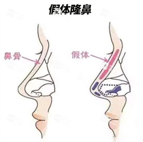 假体隆鼻对比.jpg 假体隆鼻对比.jpg