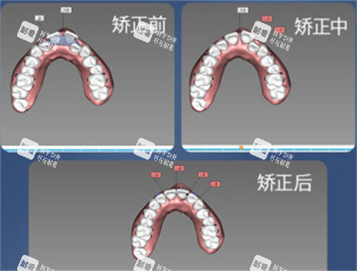牙齿矫正设计图.jpg 牙齿矫正设计图.jpg