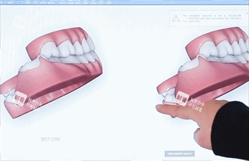 隐形牙齿矫正3D模型展示.png 隐形牙齿矫正3D模型展示.png
