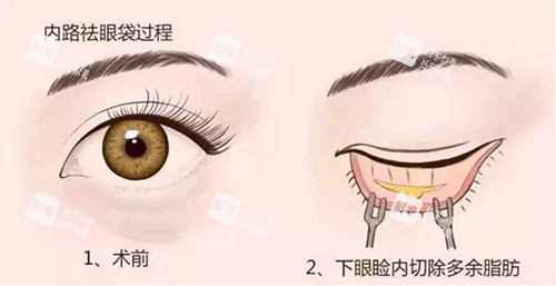 去眼袋手术.jpg
