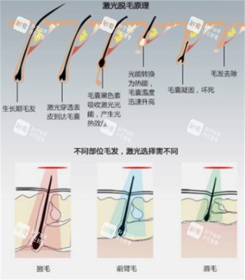 激光脱毛前后对比.jpg