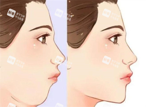 双下巴抽脂前后对比侧面动画图.jpg