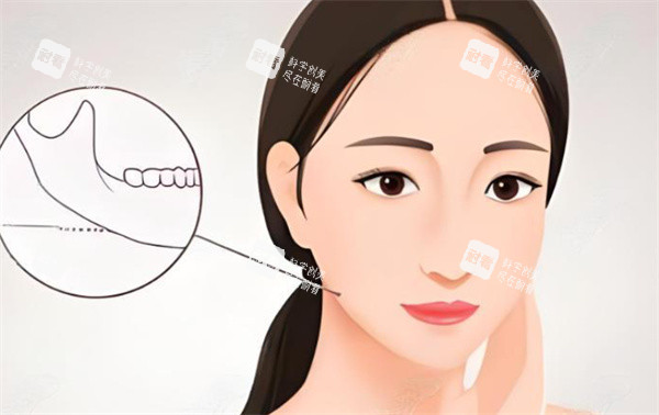 下颌角整形手术卡通图.jpg