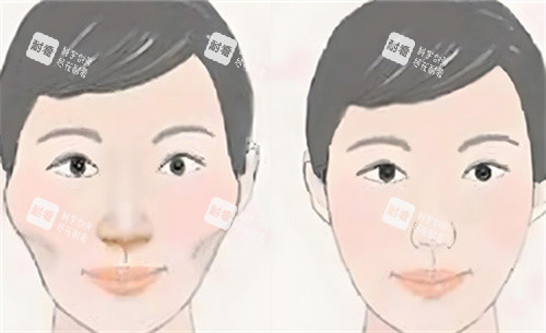 颧骨内推术前后对比动画图.jpg