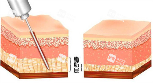 吸脂手术怎么做的.jpg 吸脂手术怎么做的.jpg