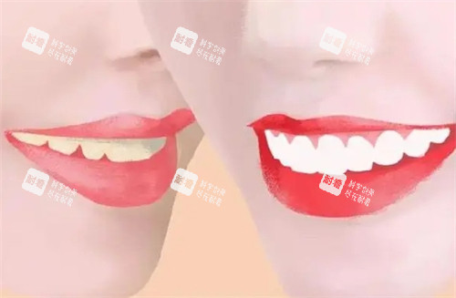牙齿美白前后对比图.jpg 牙齿美白前后对比图.jpg
