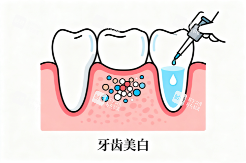 牙齿美白卡通展示图.png 牙齿美白卡通展示图.png