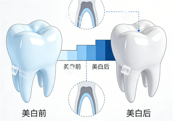 牙齿美白前后示意图.jpg 牙齿美白前后示意图.jpg