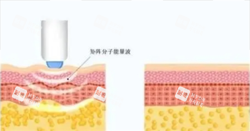 热玛吉项目皮肤剖面图.png