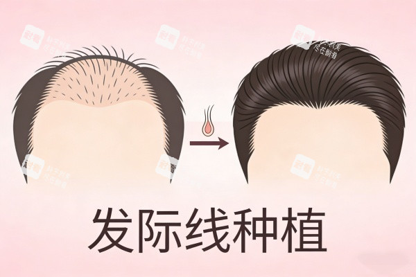 发际线种植前后对比图展示.jpg 发际线种植前后对比图展示.jpg