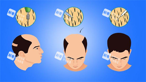 男性毛发移植对比动画图.jpg