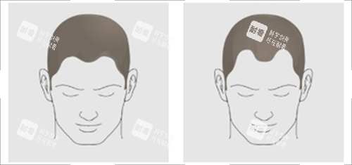 发际线对比.png