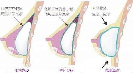 假体隆胸包膜挛缩.png