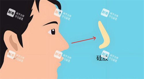 硅胶假体隆鼻.jpg
