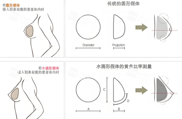 隆胸假体形状对比.png