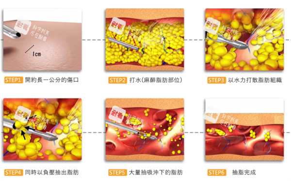 吸脂过程详细图解.jpg 吸脂过程详细图解.jpg