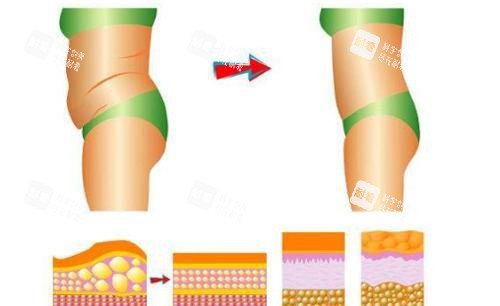 腰腹吸脂对比图.jpg 腰腹吸脂对比图.jpg