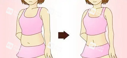 腰腹吸脂对比卡通图.jpg 腰腹吸脂对比卡通图.jpg