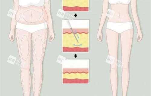 大腿环吸前后对比卡通示意图.jpg 大腿环吸前后对比卡通示意图.jpg