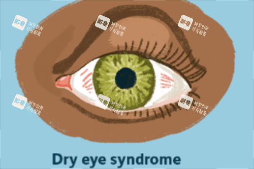 干眼综合征.png