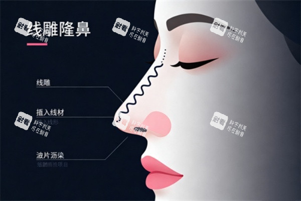埋线隆鼻卡通展示图.jpg