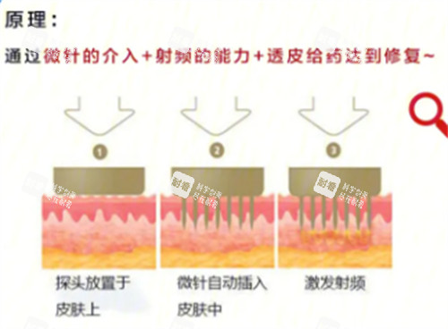 黄金微针原理分析.jpg