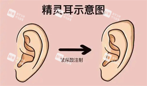 精灵耳注射.jpg