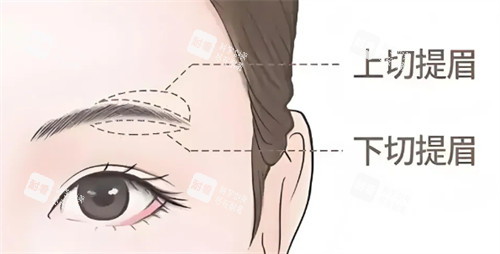 提眉术式区别.jpg