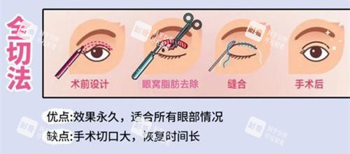 双眼皮手术全切法动画演示图.jpg